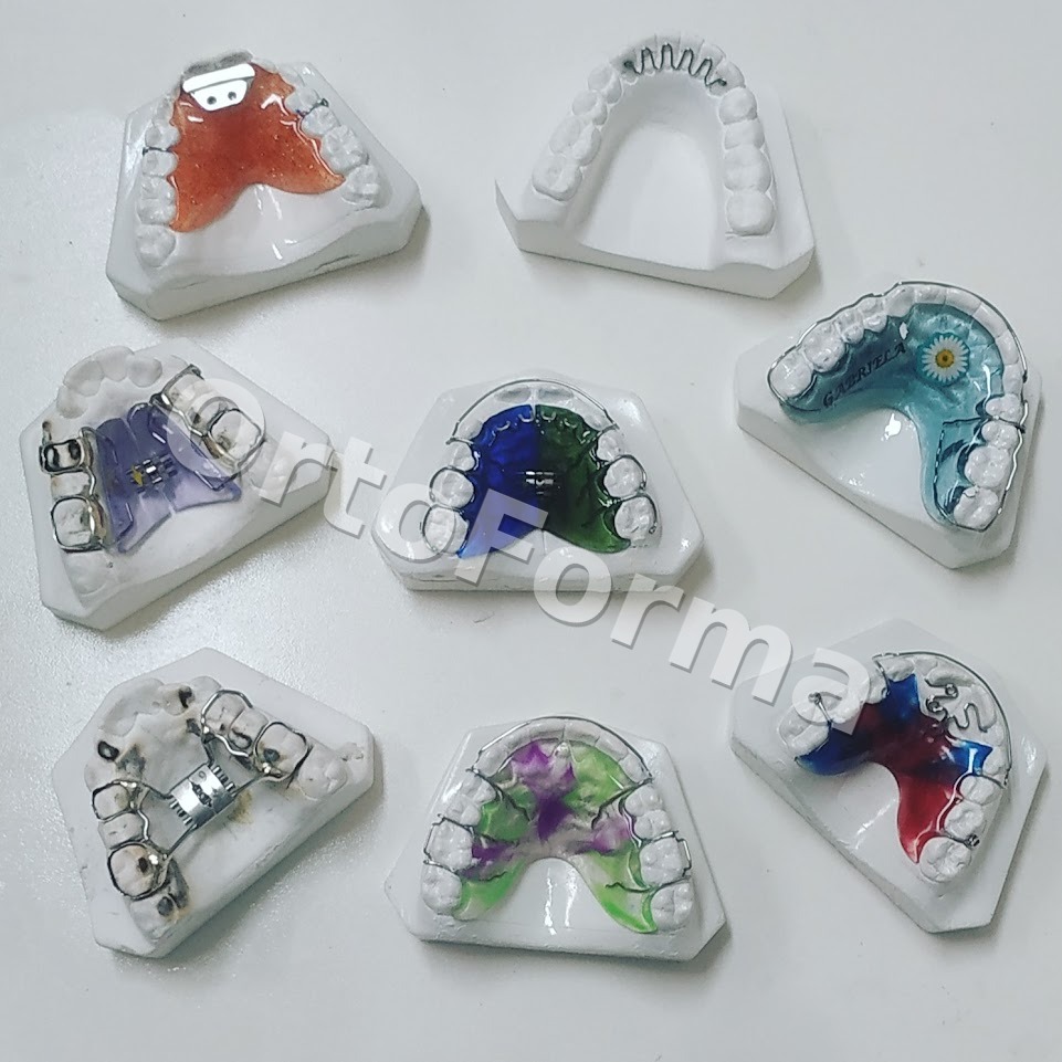 Aparelho ortodôntico produzido pela OrtoForma para clínicas da Baixada Santista